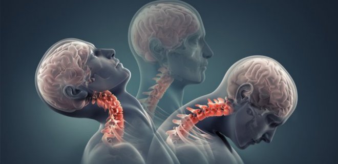 boyun fitigi nedir belirtileri ve tedavi yontemleri