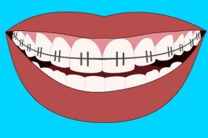 ortodonti tedavi nedir