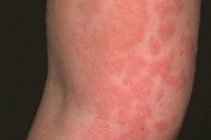 alerji nedir neden olur belirtileri nelerdirili