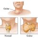 TSH (tiroid hormonu) yüksekliği nedenleri, belirtileri ve tedavisi