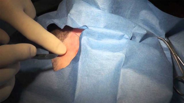 basur hemoroid nedir basur belirtileri ve basur tedavi yontemleri nedirmel