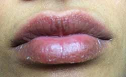 dudak-sisligi-tedavisi