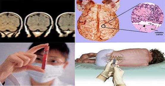 menejit nedirmenenjit hakkinda detayli bilgi h