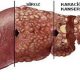 Karaciğer neden büyür, karaciğer büyümesinin nedenleri, hangi hastalık belirtisidir